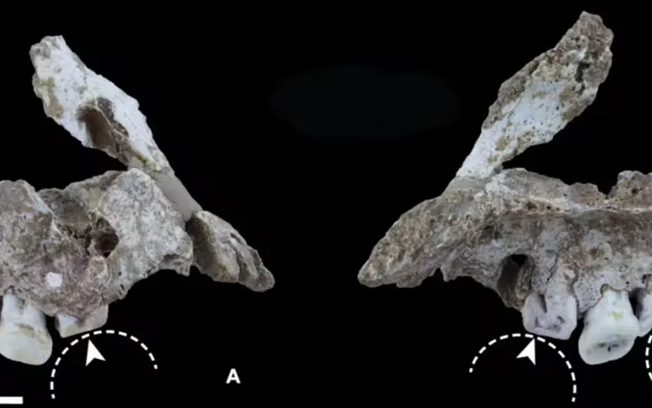 Ancient tooth grooves caused by betel nut-sucking.