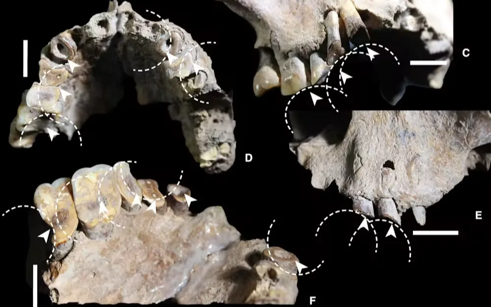 Ancient tooth grooves caused by betel nut-sucking.